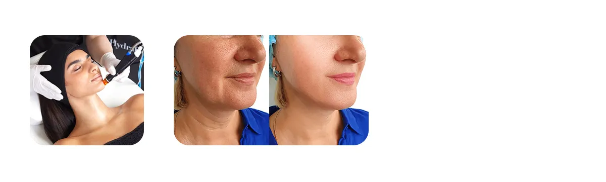 HydraFacial 