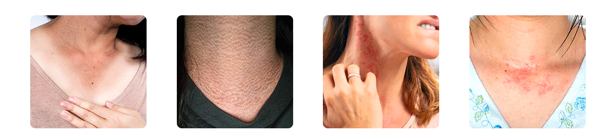 what is black neck