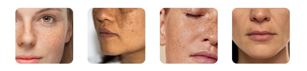 types of pigmentation