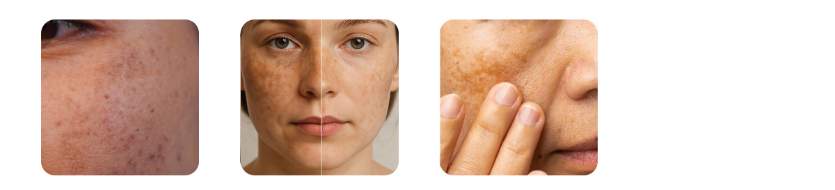 symptoms of melasma 