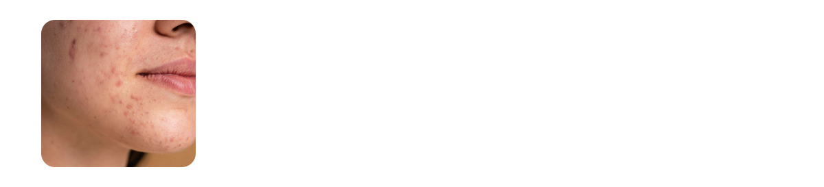 your skin barrier is compromised