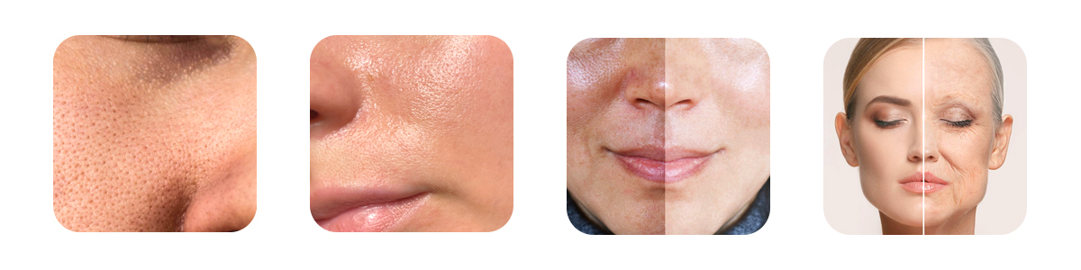 key skin concerns the carbon laser peel