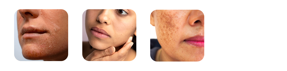 what hydra q tone treats