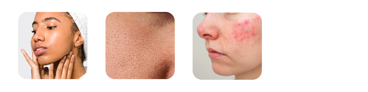 sugar and acne a direct connection