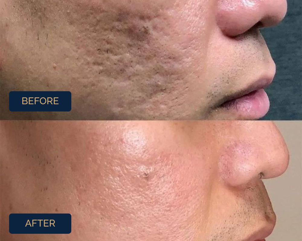 Best-Acne-Scar-Treatment-In-Delhi