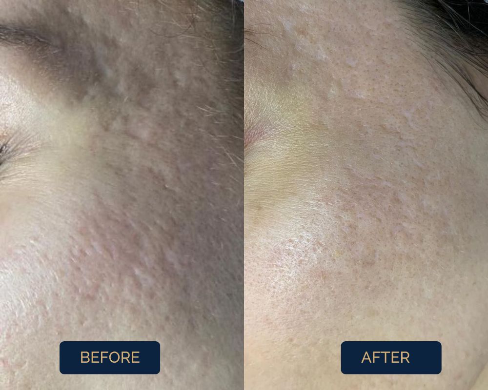 Fractional-Laser-Acne-Scar-Removal
