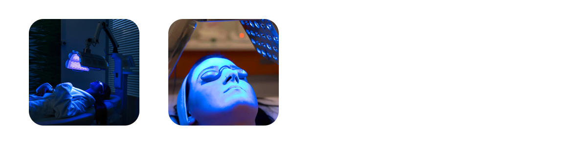 how smart photodynamic therapy targets acne