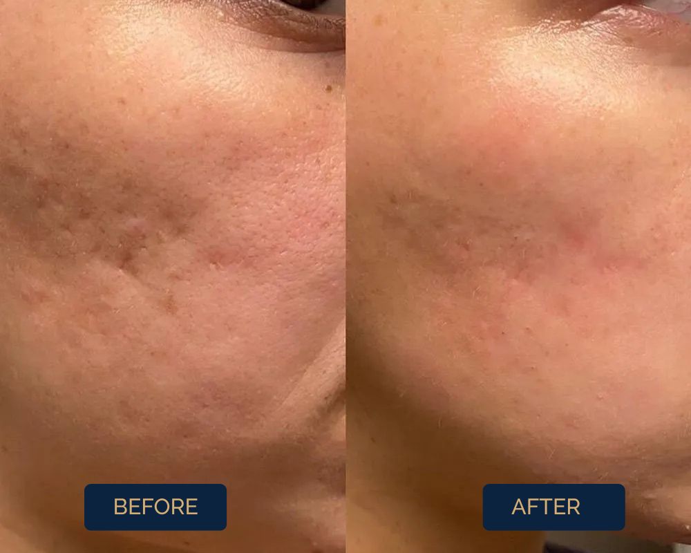 microneedling-for-all-types-of-scars
