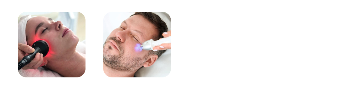 radiofrequency skin tightening