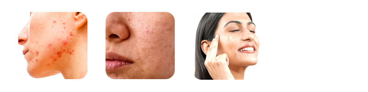 why-smart-photodynamic therapy is different from traditional acne treatments