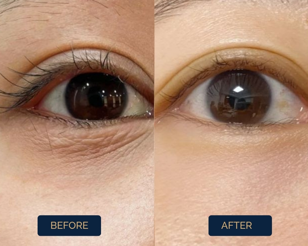 Dark Circles (2)