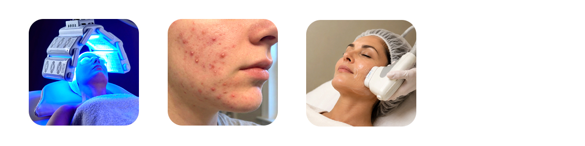 why choose auguste skin for your hydrafacial in bangalore