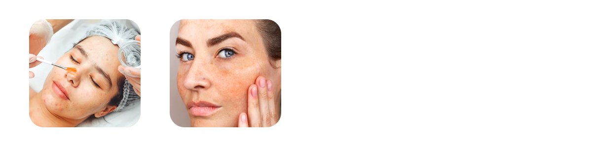 chemical exfoliation