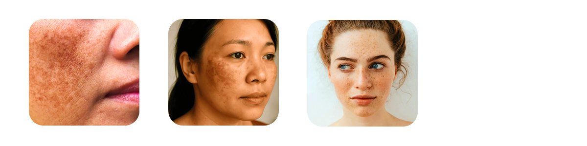 the different types of pigmentation