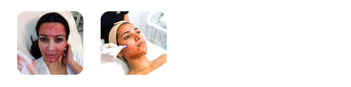 how vampire facial prp works